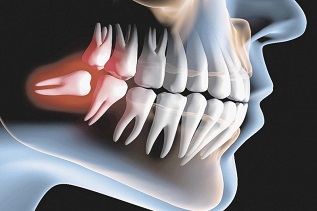 Cirurgia Avançada dos Dentes Inclusos